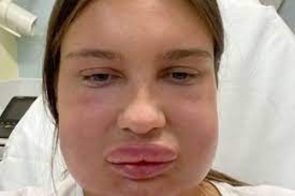 Lip Surgery कराना पड़ गया महिला को भारी, गुब्बारे की तरह फूल गए होंठ! गाल पर भी हो गया बुरा असर