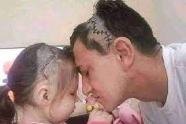 बेटी के दिमाग का हुआ ऑपरेशन तो पिता ने साथ देने के लिए किया दिल छू लेने वाला काम, फोटो हुई वायरल