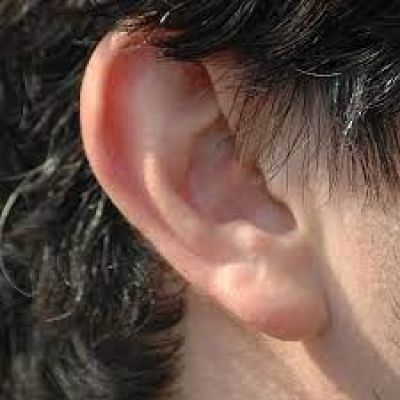 एसजीपीजीआई के प्लास्टिक सर्जनों ने 12 साल की बच्ची में किया कान का पुनर्निर्माण