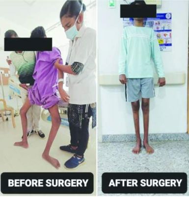 मिनीमम कट तकनीक द्वारा रामकृष्ण केयर अस्पताल में सफल जटिल हिप सर्जरी